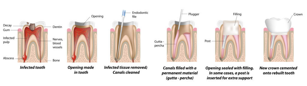 Root Canal Beverly Hills
