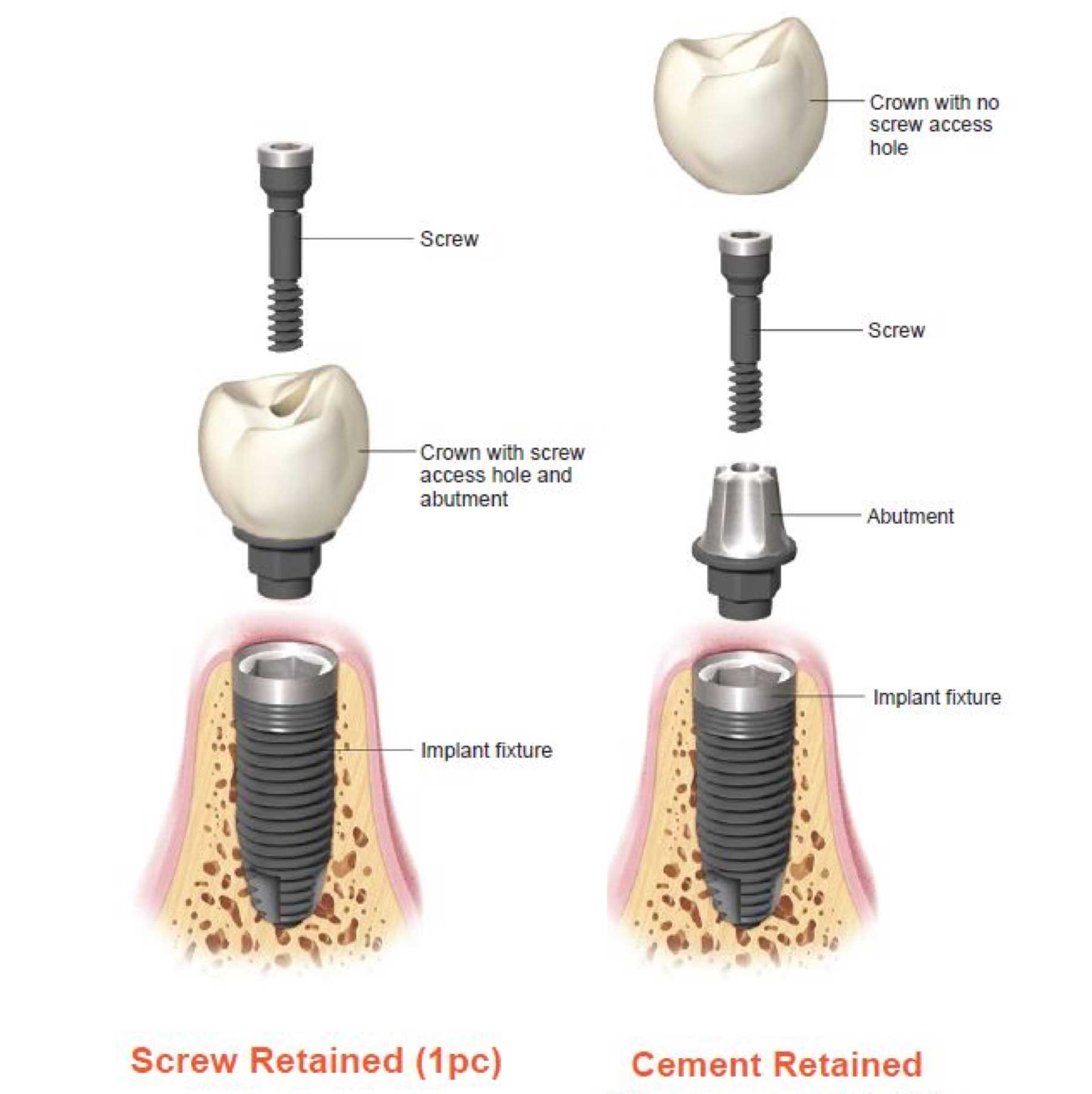 Dental Implants West Hollywood and Beverly Hills