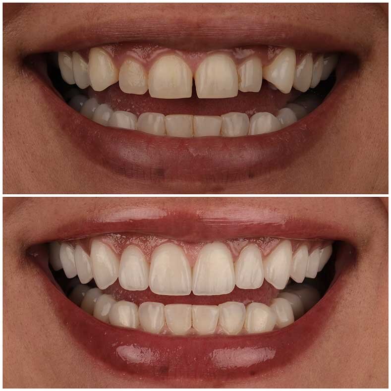 Porcelain Veneers Beverly Hills Veneers West Hollywood Dr. Borzoo