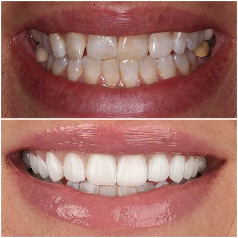 Porcelain Veneers Beverly Hills Veneers West Hollywood Dr. Borzoo