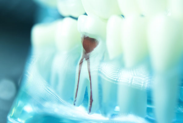 Root Canal Beverly Hills