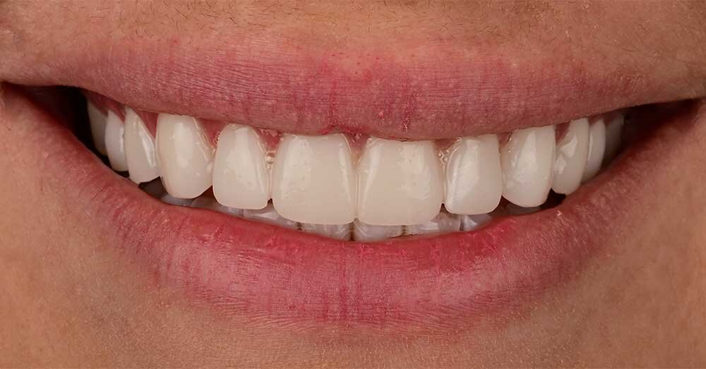 Porcelain Veneers Beverly Hills Veneers West Hollywood Dr. Borzoo