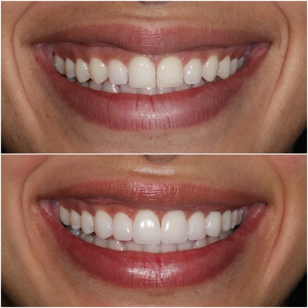 No Prep Veneers Beverly Hills | West Hollywood Veneers