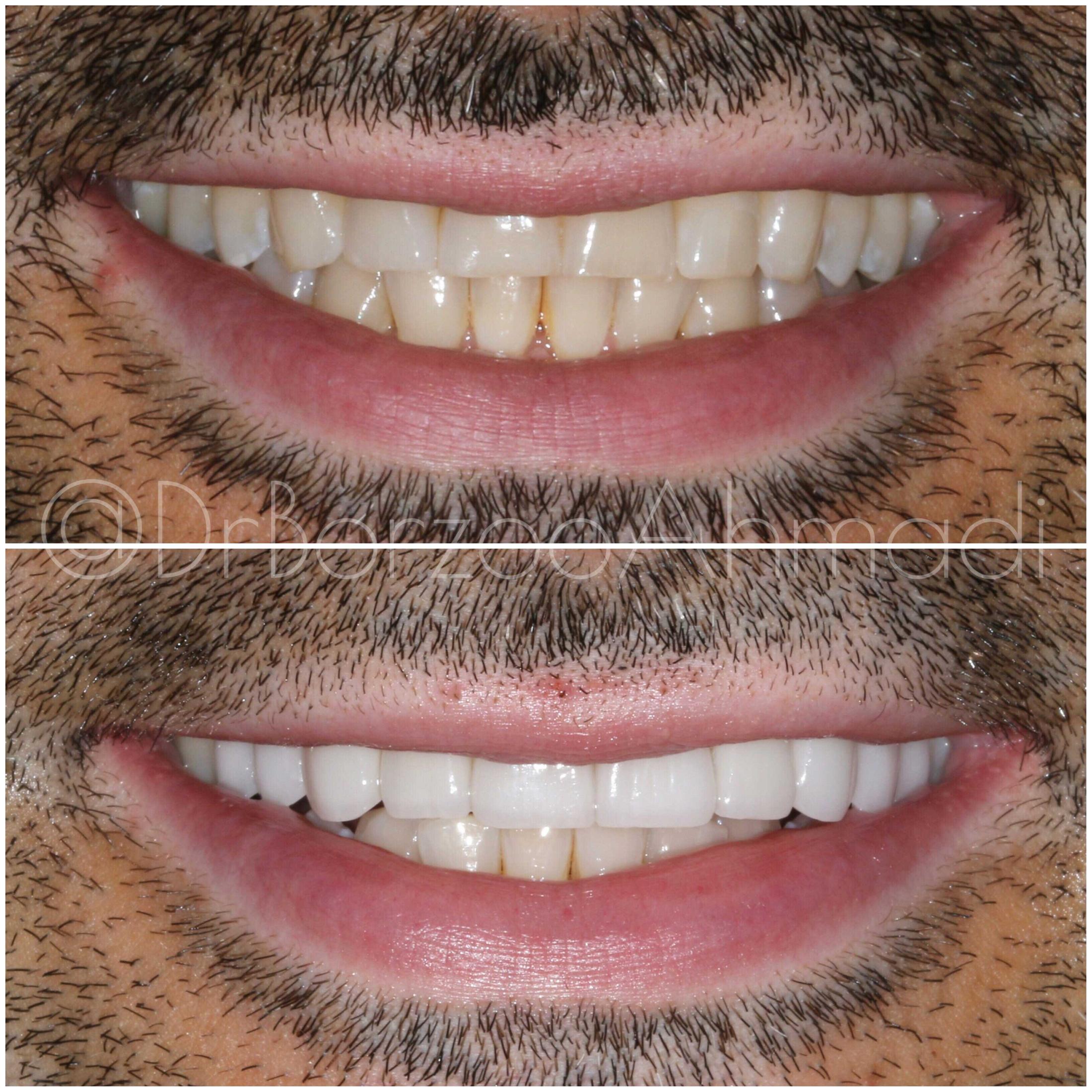 Veneers for Stained Teeth West Hollywood and Beverly Hills