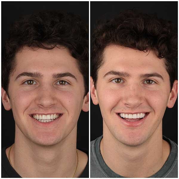 Porcelain Veneers Beverly Hills Veneers West Hollywood Dr. Borzoo